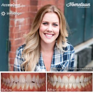 Before and After Photo of Patient Using Invisalign