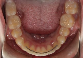 Lower fixed retainer of patient treated in Mississauga