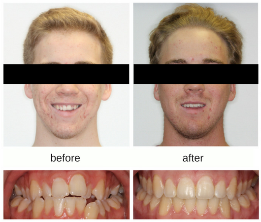 Before and After photo of adult treated with braces and extraction of single tooth in Sudbury, Ontario