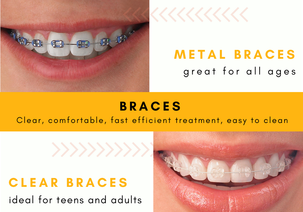 Braces: Types, Info  Hometown Orthodontics - Mississauga, Sudbury