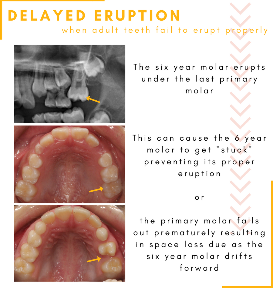 Delayed Tooth Eruption In Kids Hometown Orthodontics