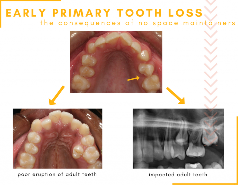 Early Tooth Loss in Children Hometown Orthodontics