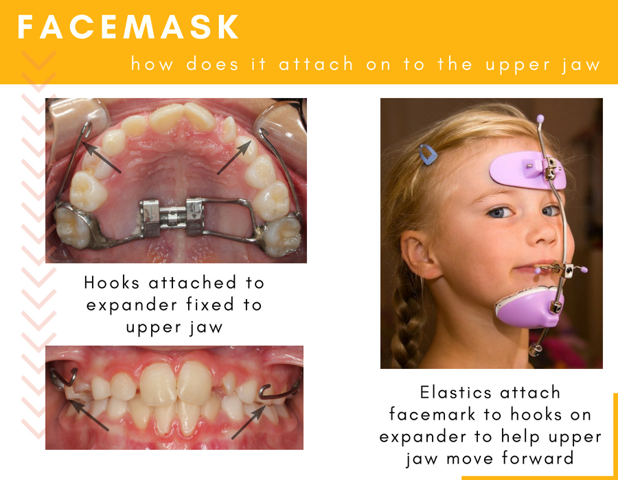 Facemask Underbite Mississauga Kids Dentist Sudbury Childrens dentist