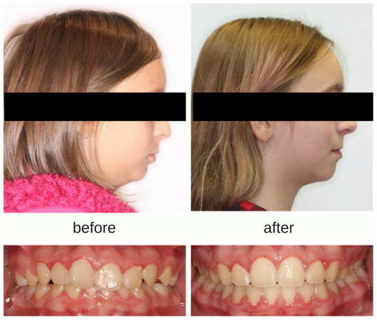 Before and after profile photo of female patient treated with the Herbst appliance showing growth of the lower jaw