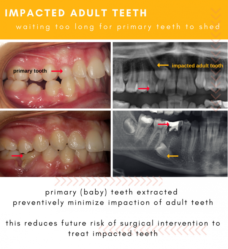 delayed-tooth-eruption-in-kids-hometown-orthodontics