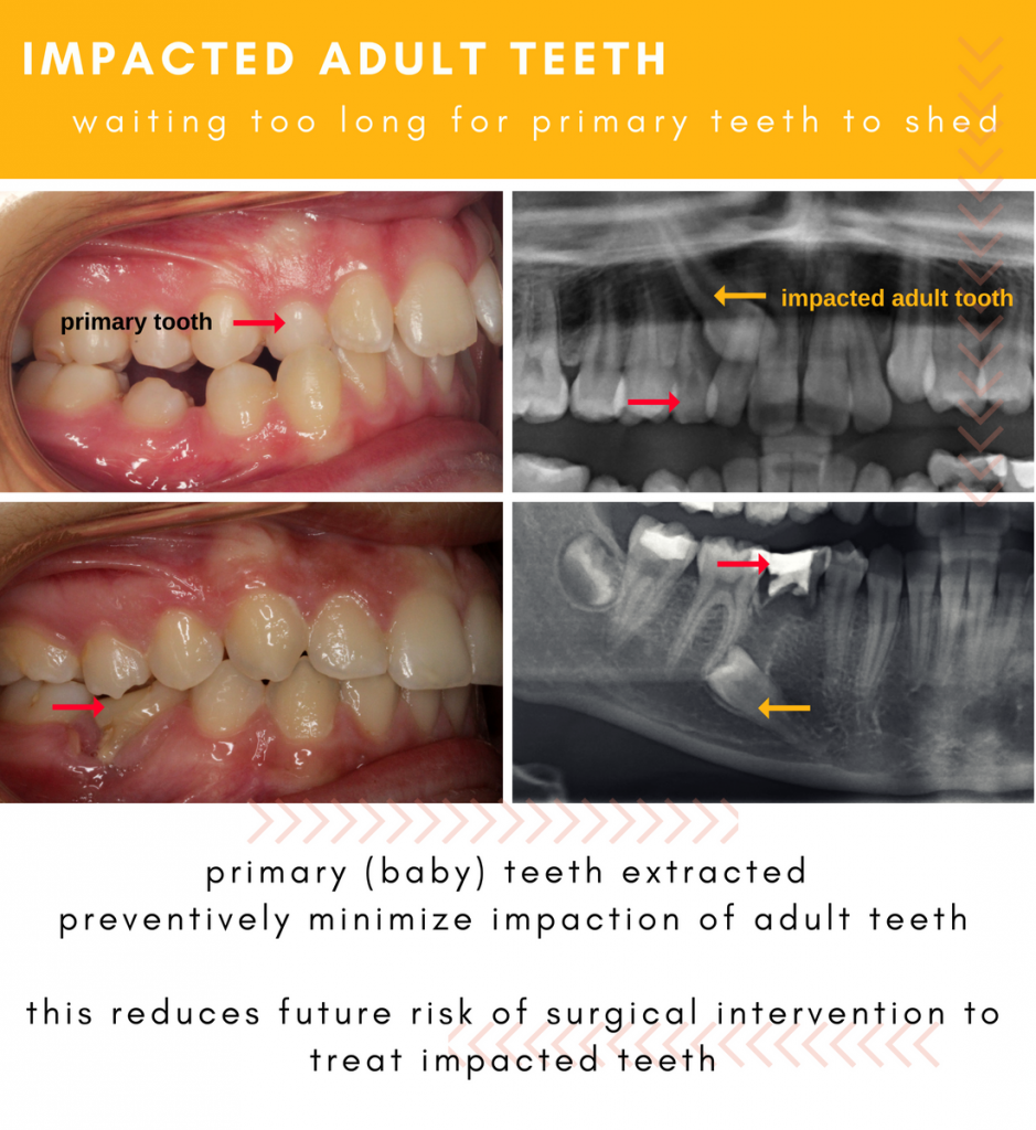 Delayed Tooth Eruption in Kids | Hometown Orthodontics