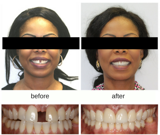 Before and after photo of adult female patient with large gap between the two front teeth treated with Invisalign in Sudbury, ON