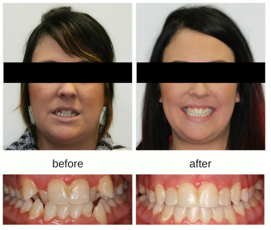 Before and After of Invisalign treatment on an adult female