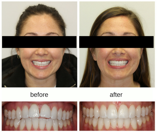 Invisalign before and after for an adult female patient