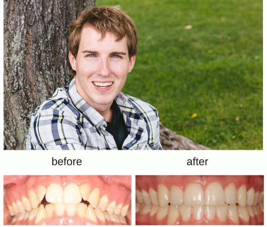 Before and After photo of patient treated with Invisalign in Sudbury, Ontario