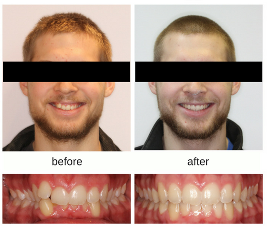 Before and after photo of patient treated with Invisalign in Sudbury, Ontario
