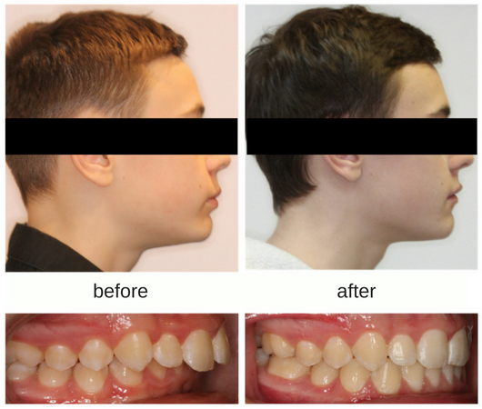 Before and after photo of male patient treated with Herbst Appliance