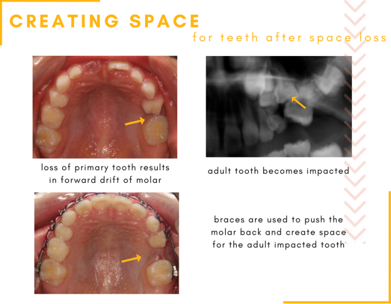 Early Tooth Loss in Children Hometown Orthodontics