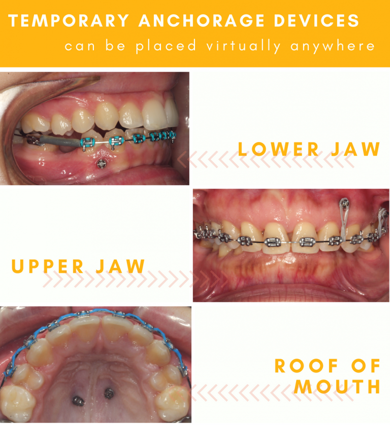 Temporary Anchorage Devices | Hometown Orthodontics