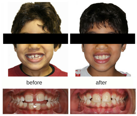 Before and after photo of male patient who was treated with a tongue crib
