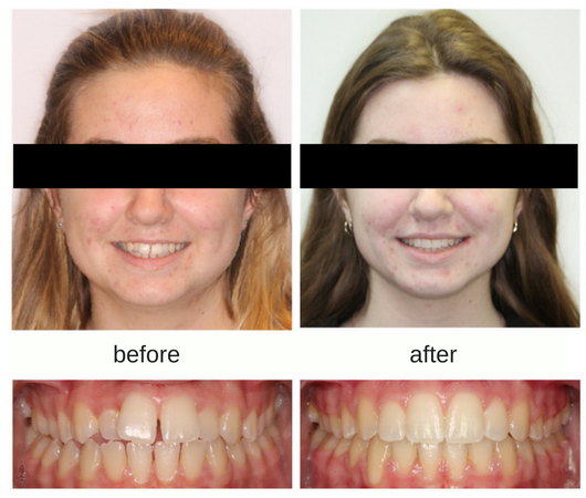 Before and after photo of young female patient with crowding treated with braces in Sudbury