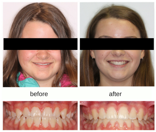 Before and after photo of patient with underbite treated with braces