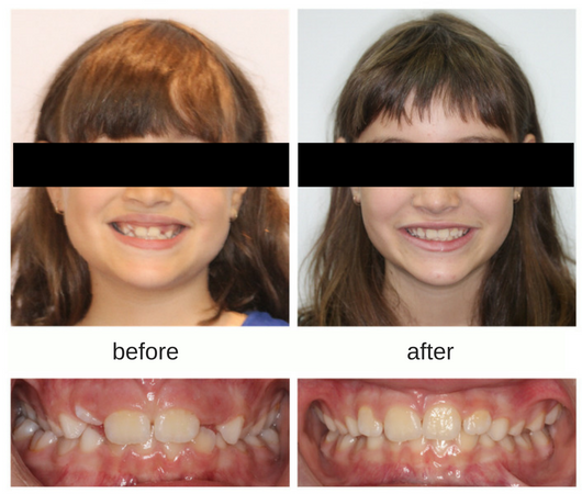 Before and after photo of female patient with a crossbite treated with expansion therapy