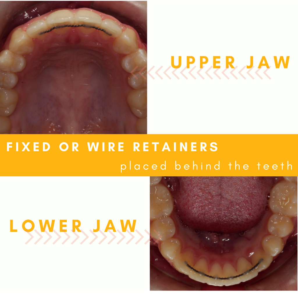 All About Retainers Types and FAQ Hometown Orthodontics