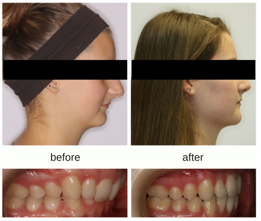 Before and after of orthodontics with jaw surgery