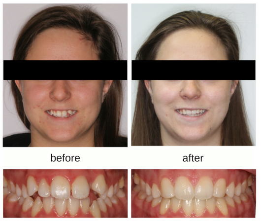 hypodontia before and after