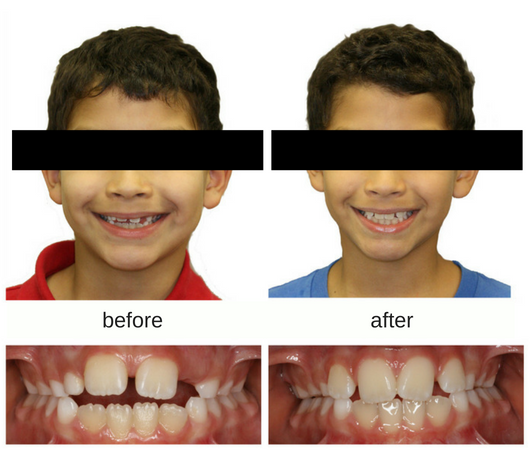 Before and after photo of young male patient who was treated with tongue crib
