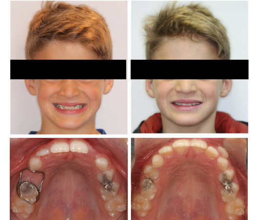 Before and After photo of Patient who lost a baby tooth early treated with band and loop space maintainer