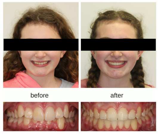 Before and after photo of young female patient with overbite and crowding treated with braces in Mississauga