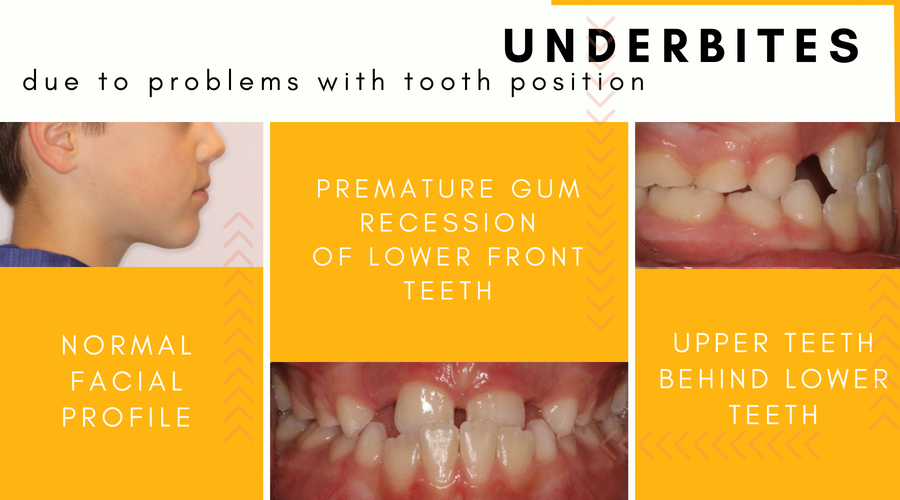 Teeth underbite Underbite: Causes,