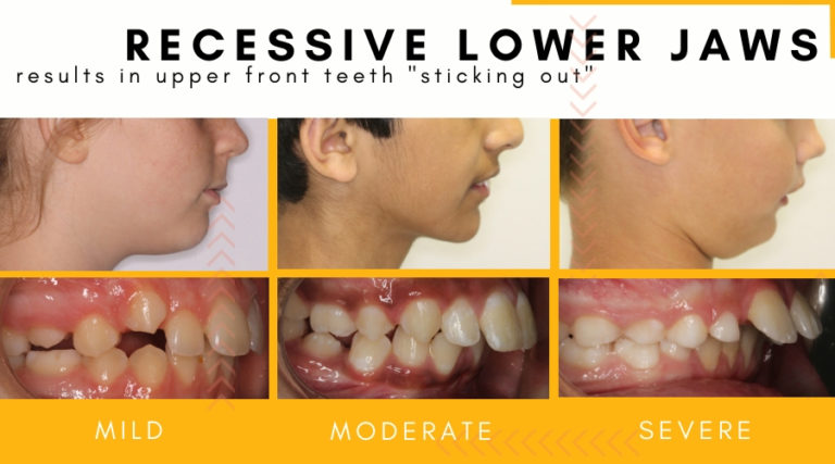 Recessive Lower Jaw In Kids Hometown Orthodontics