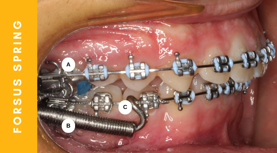 Forsus Springs at hometown Orthodontics 