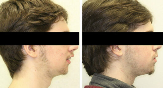 Before and After photo of patient treated with lower jaw advancement using surgical orthodontics in Mississauga