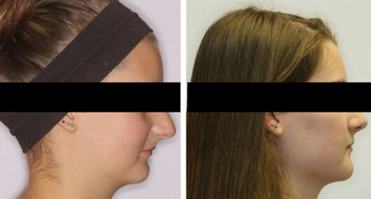 Before and After Photo of patient treated with surgical orthodontics (double jaw advancement)