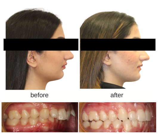 Before and After photo of patient with surgical orthodontics (lower jaw advancement) treated in Mississauga, Ontario