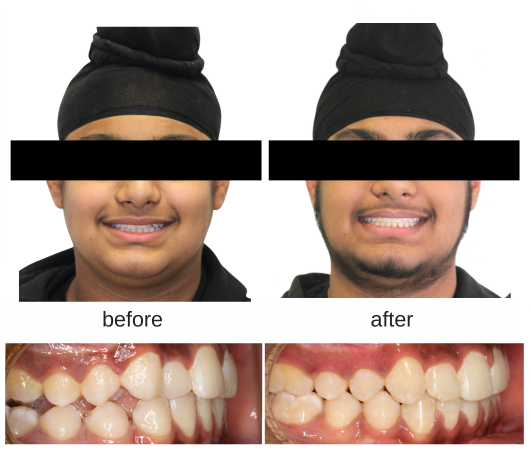 Class II Elastics before and after image 4