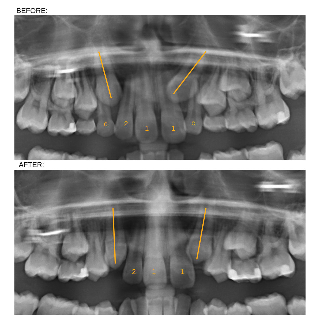 Impact of removing primary canines case 4