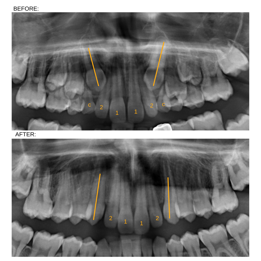 Impact of removing primary canines case 3