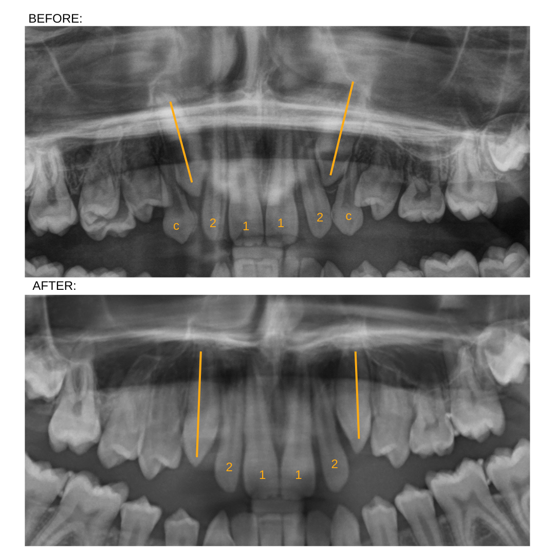 Impact of removing primary canines case 2