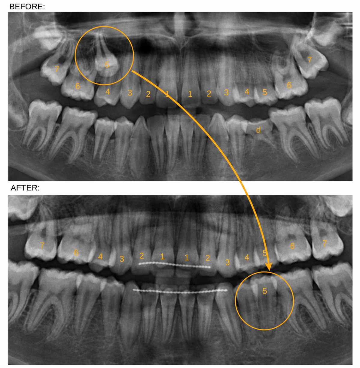 Autotransplantation case
